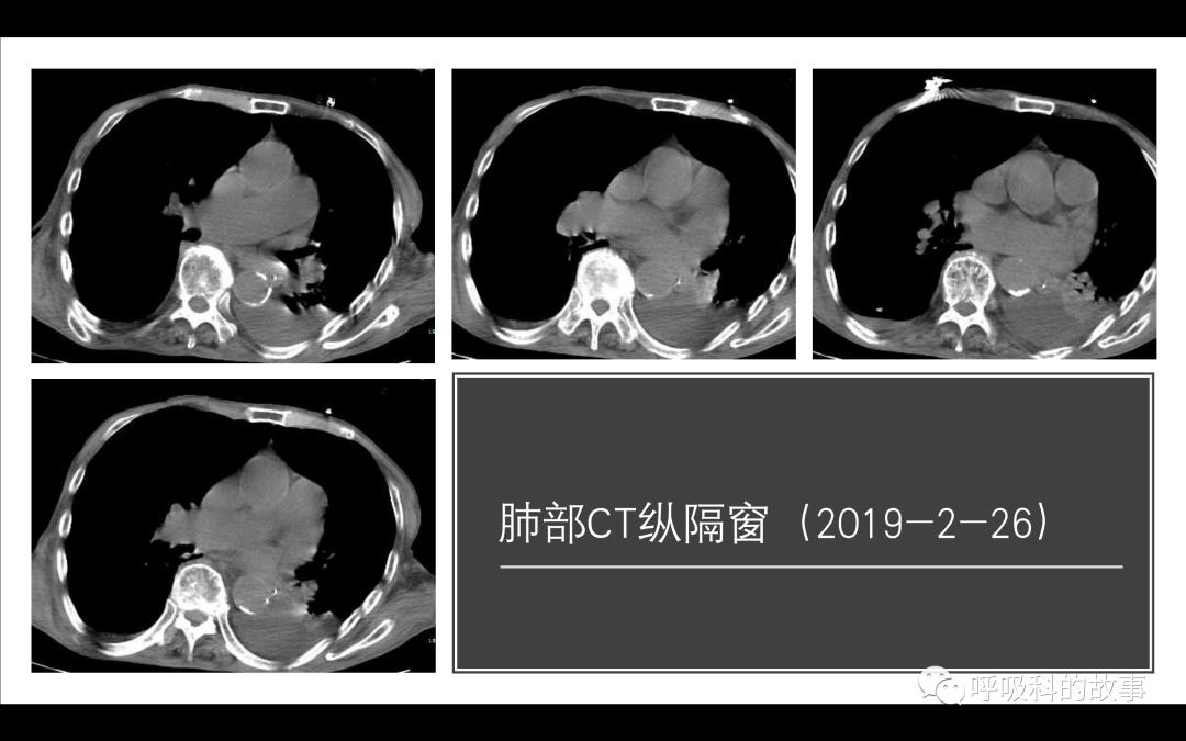 痰液培养阳性是否一定要用抗菌素？——为什么临床微生物学思维很重要（2）
