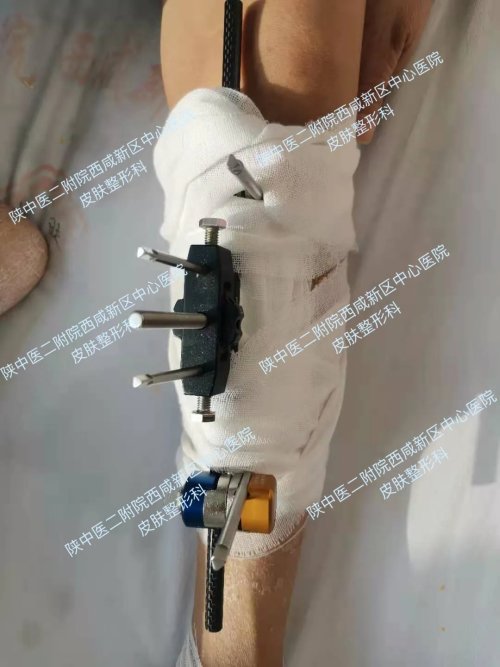 糖尿病足中医帮你消除截肢危险,警惕来自糖尿病足的截肢警告