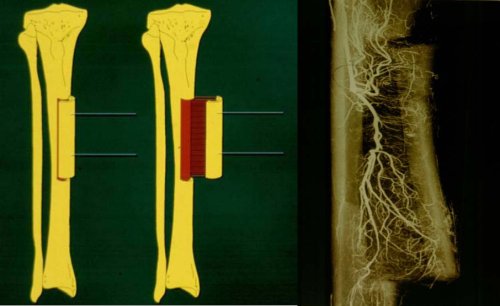糖尿病足中医帮你消除截肢危险,警惕来自糖尿病足的截肢警告