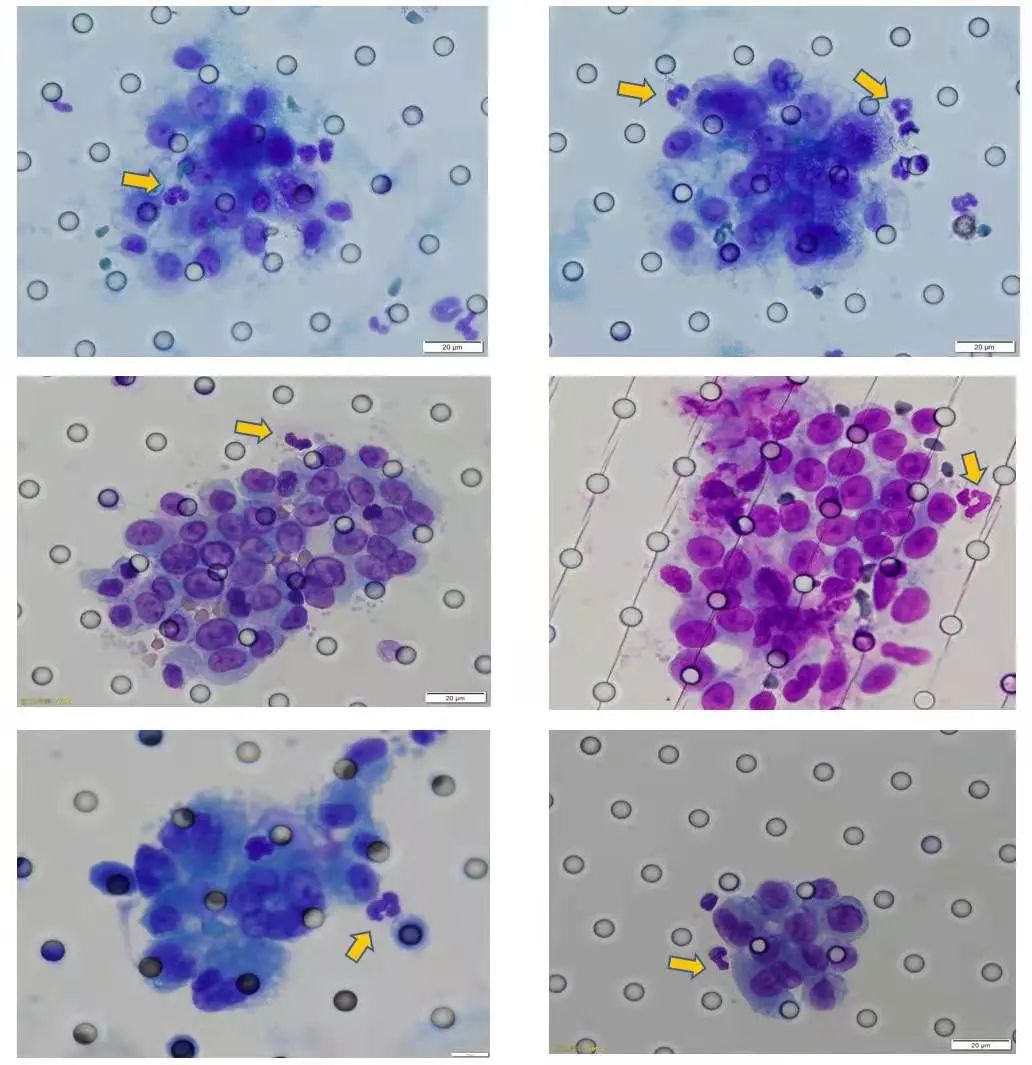 武汉大学中南医院携手芝友医疗发现恶性肿瘤转移亿分之一的“秘密”