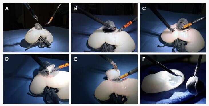 目前治愈肾癌的最好方法,早期肾癌的最新治疗方法