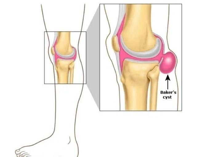 关节镜微创取游离体,关节镜下腘窝切除手术记录