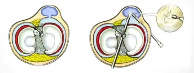 关节镜微创取游离体,关节镜下腘窝切除手术记录