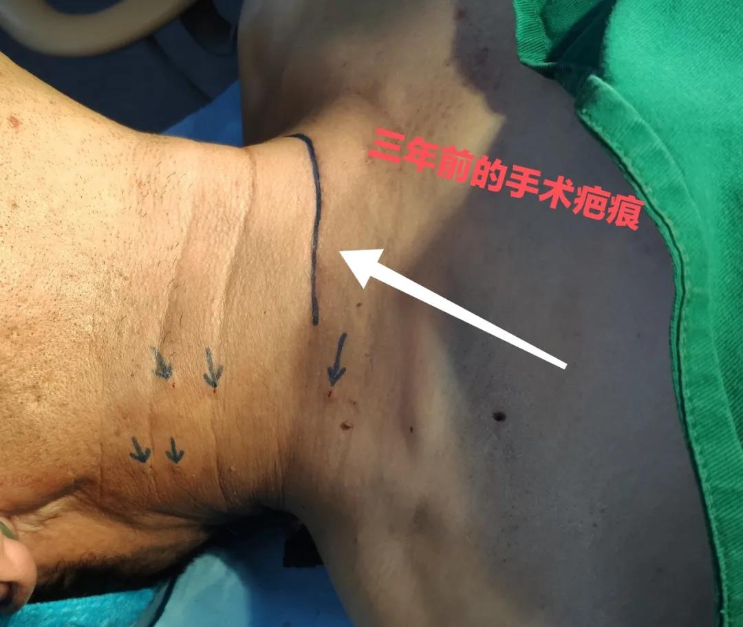 甲状腺癌根治术后颈部淋巴结转移,甲状腺癌术后淋巴结转移怎么办