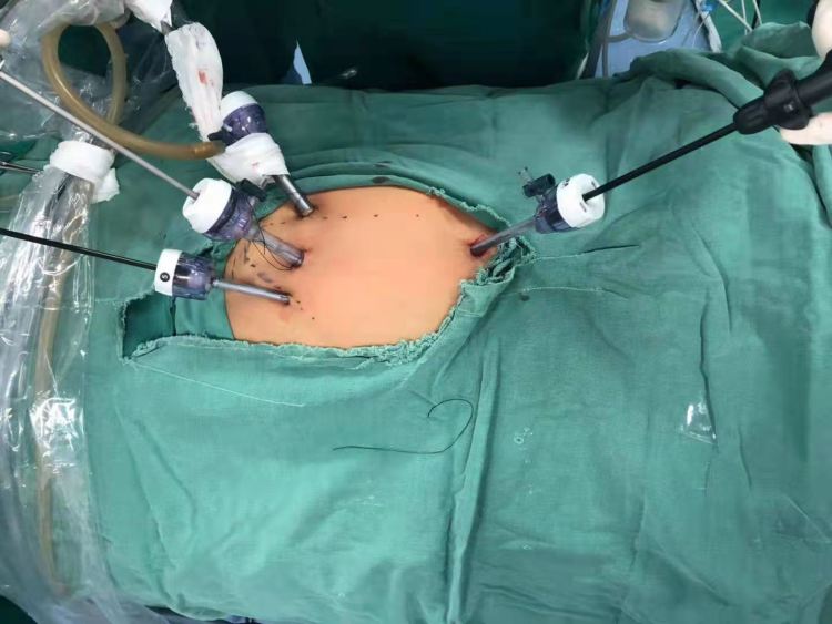 腹腔脏器修补术有哪些,腹腔镜空腔脏器修补术