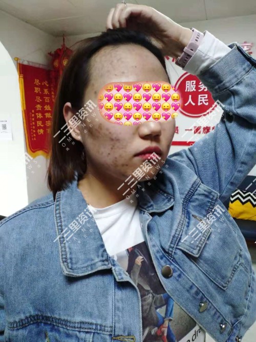 花几千块钱去美容院治痘会好吗,花2万元祛斑彻底祛除了值得吗