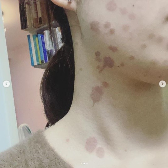 女星吃香肠被烧伤,女星炸香肠二级烧伤