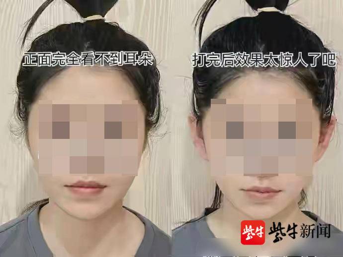 耳朵太大可以做整形变小么,如何让耳朵变成精灵耳