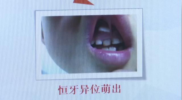 幼儿乳牙蛀牙,儿童乳牙蛀牙只剩牙根怎么办