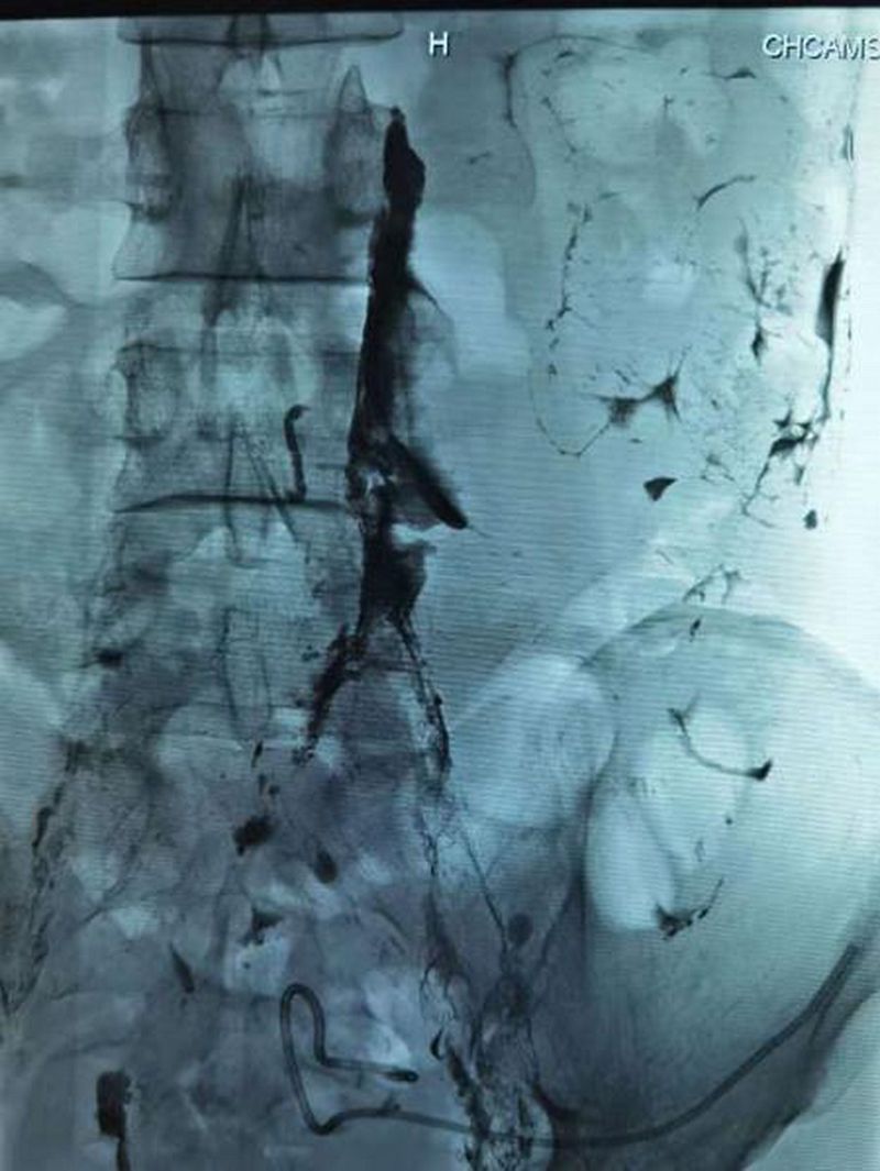 微创免费治疗成功案例,微创淋巴手术