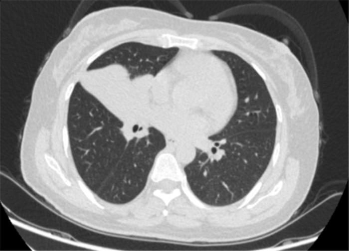 肿瘤的姑息治疗或辅助治疗根治,肿瘤的免疫治疗和介入治疗