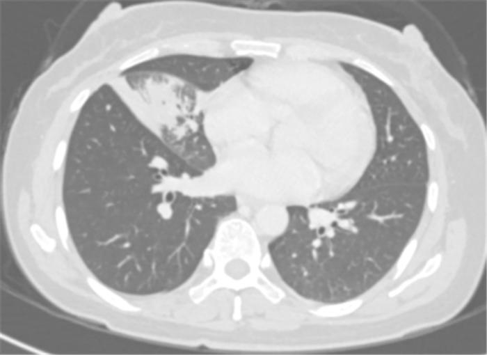 肿瘤的姑息治疗或辅助治疗根治,肿瘤的免疫治疗和介入治疗