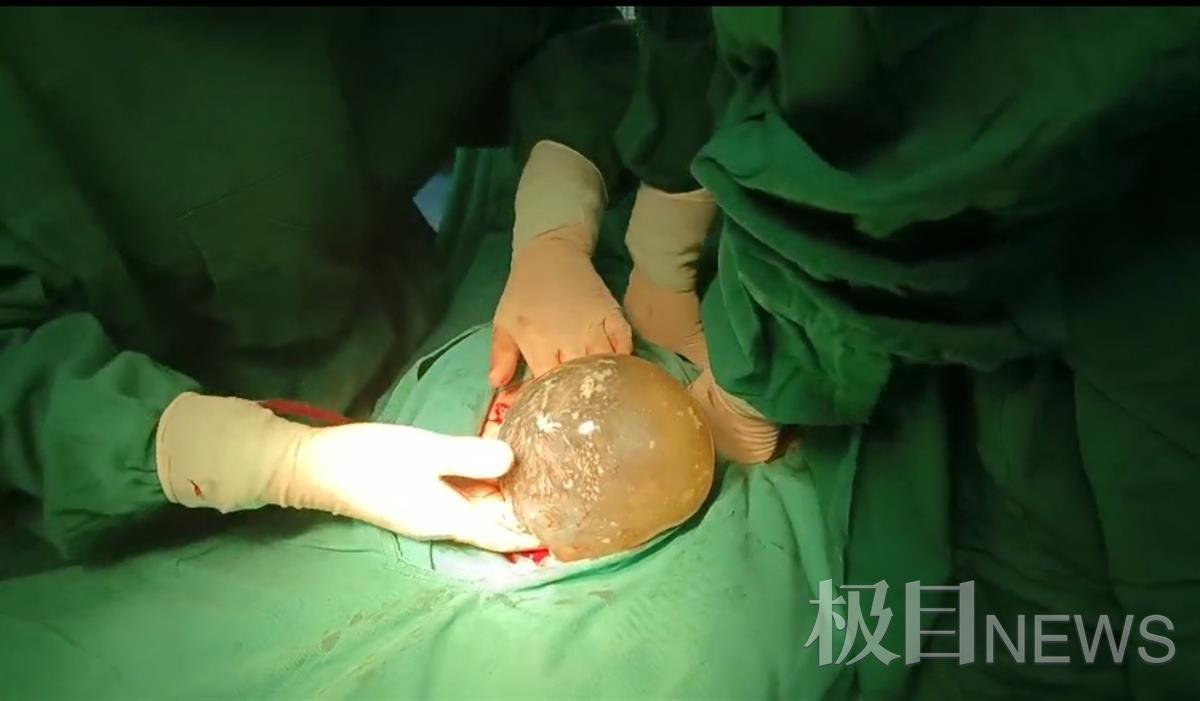 孕妇胆汁酸高胎儿死亡,胆汁酸高孕妇需要剖腹产吗