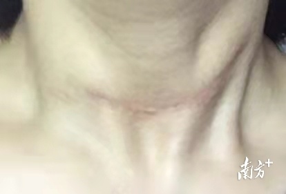 脖子甲状腺肿瘤怎么样做微创手术,无痕甲状腺手术