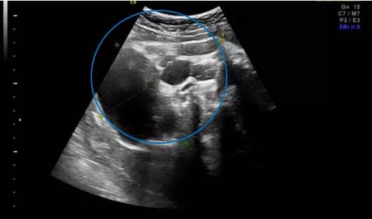 产检查出胎儿右肾有囊肿咋办,胎儿臀部肿瘤