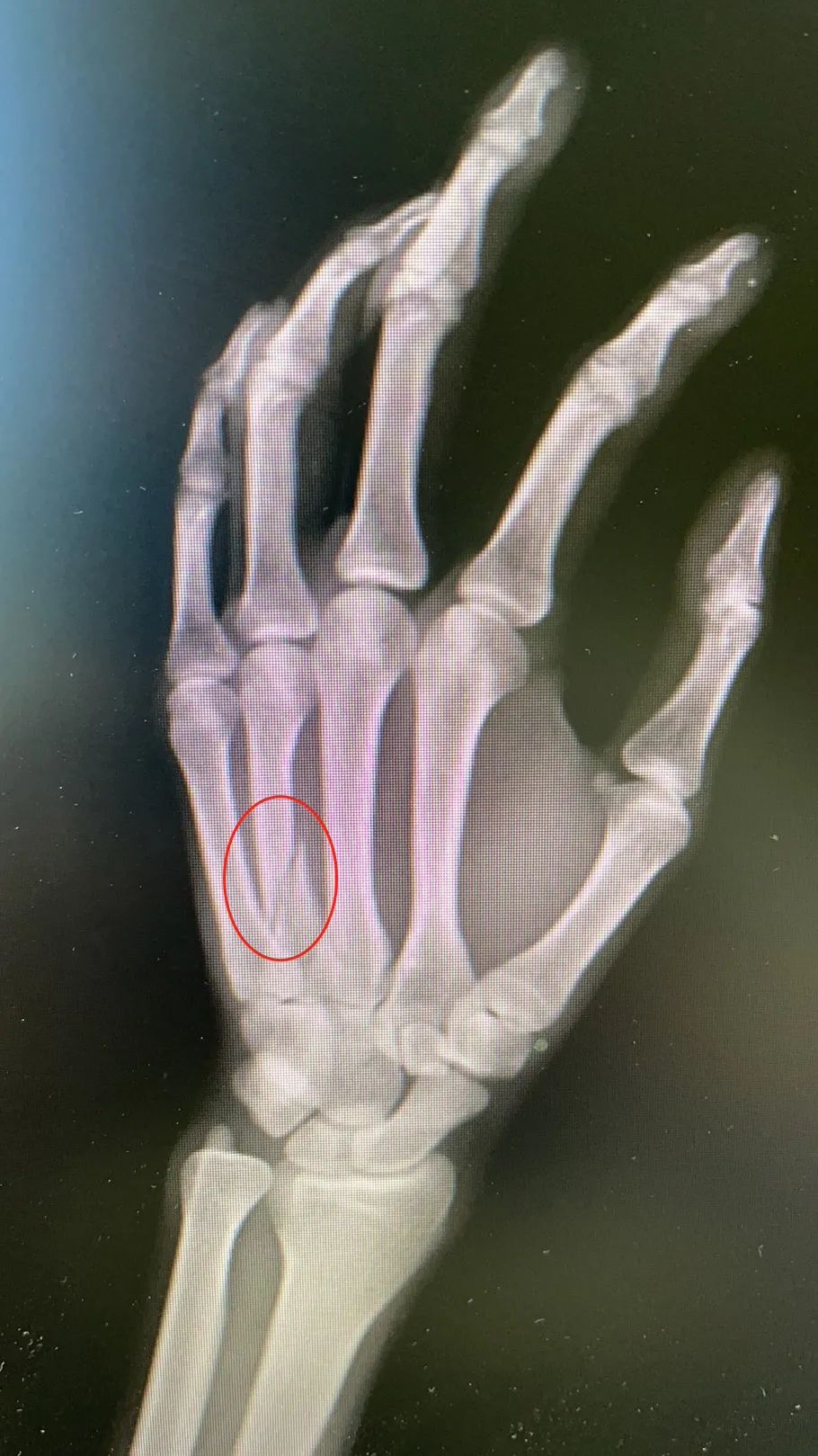 儿子做作业拖拉父亲拿锤打致骨折,儿子写作业磨蹭爸爸骨折