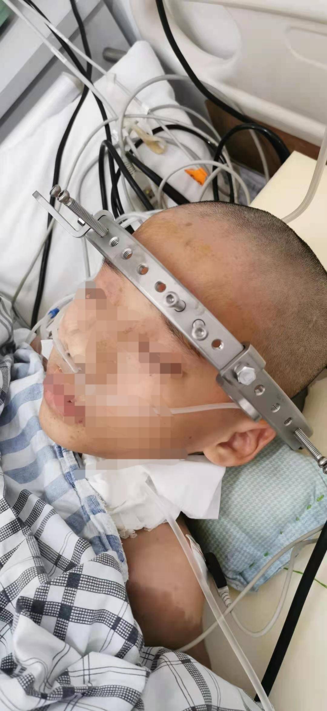 小男孩得神经纤维瘤,男孩不幸患上神经纤维瘤