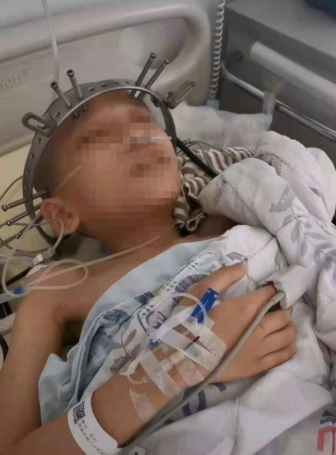 小男孩得神经纤维瘤,男孩不幸患上神经纤维瘤