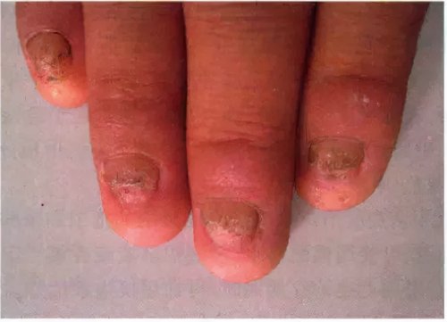 脚指甲变厚有竖纹是怎么回事,脚趾甲变黄变厚有竖纹是咋回事