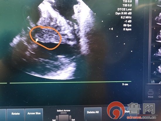 临沂市人民医院电除颤操作视频,临沂人民医院人工心脏手术