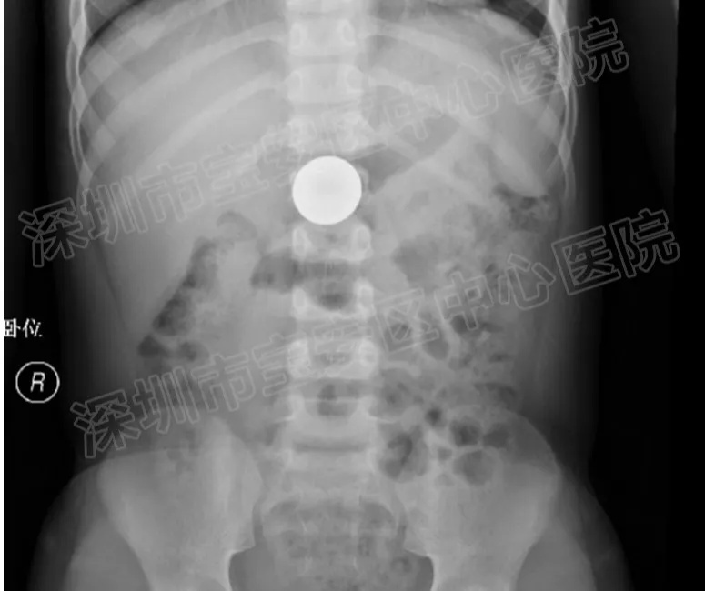 六岁小孩误吞硬币要怎么处理,儿童误吞硬币5天了还没排出来