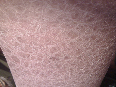 鱼鳞病有哪些治疗的方法,鱼鳞病的病因及症状