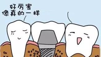 种植牙后对牙齿美学的改变,种植牙齿最后一步需要关注什么