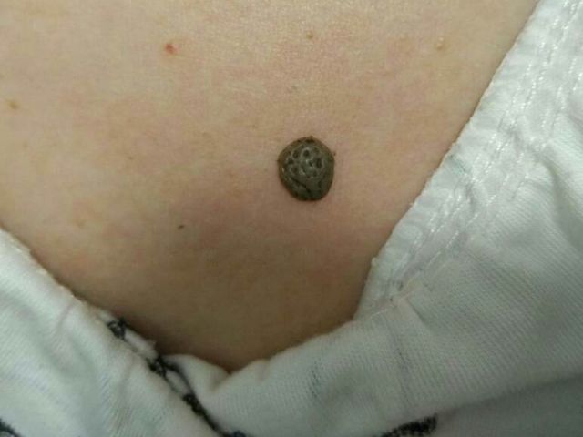 国际癌症日宣传内容,肉瘤发展过程