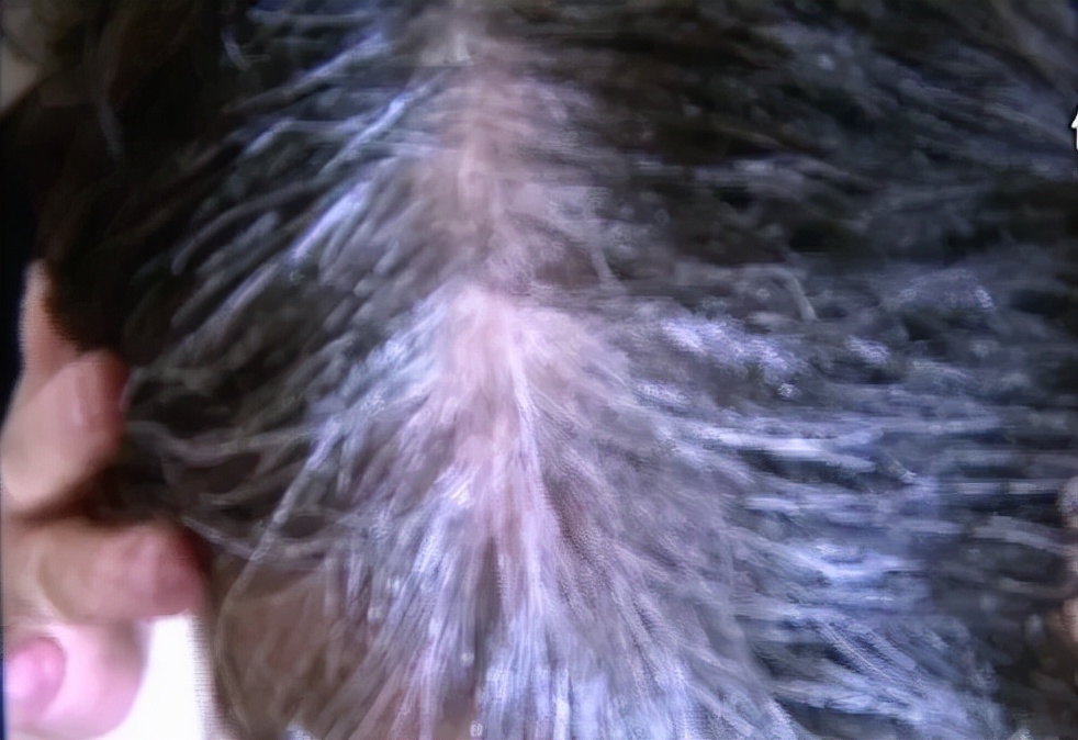 女子花了400多万整容,女子花4万元治疗白头发