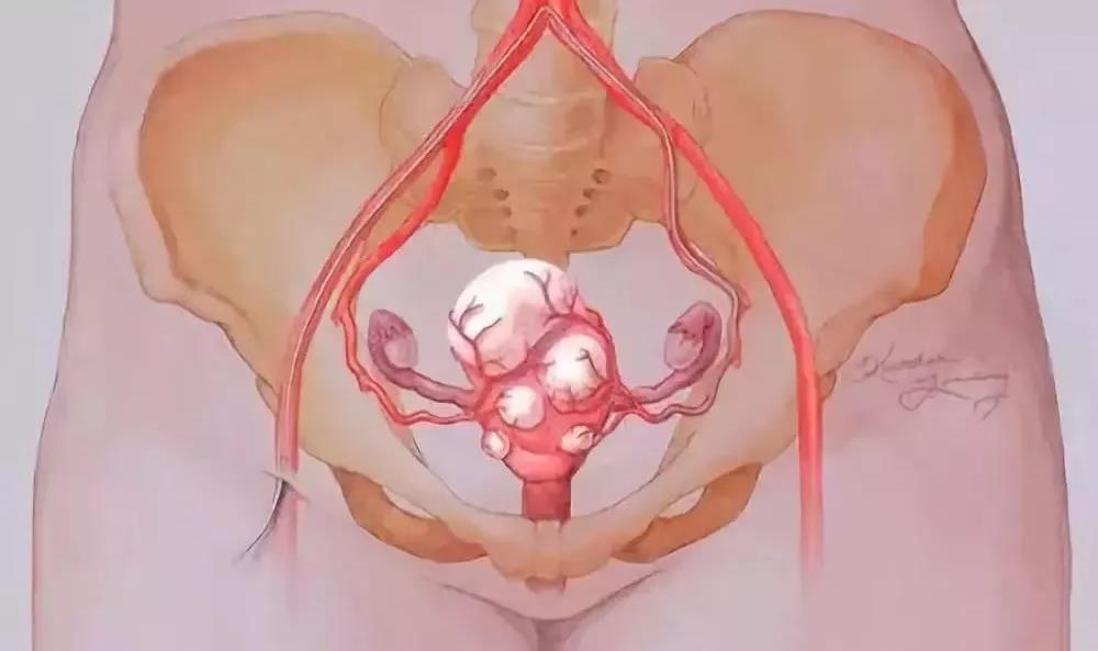 子宫肌瘤的四种常用治疗方法,子宫肌瘤有什么好的治疗方法