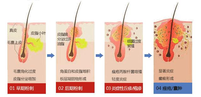 化妆不化妆都长痘,一化妆就长痘和痒怎么回事