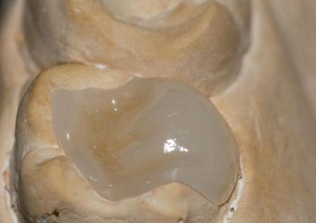 没有牙髓用根管治疗吗,牙体牙髓治疗与根管治疗的区别