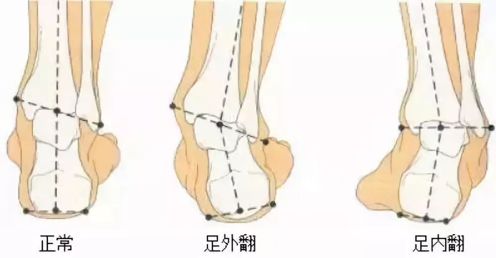 孩子脚跟疼是什么原因,孩子脚疼还肿怎么回事