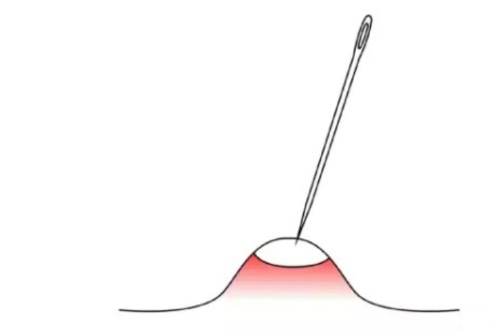 挤痘是正确的吗,关于挤痘痘的几点忠告
