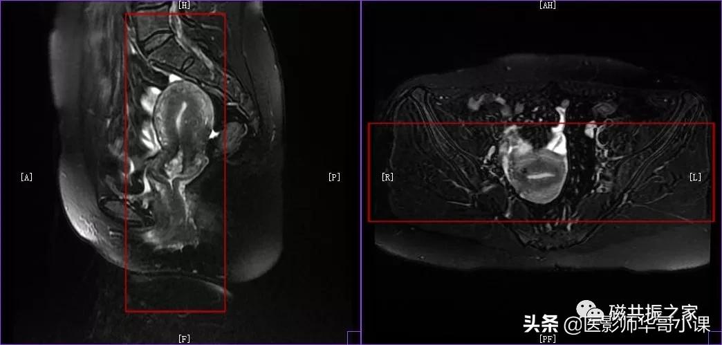 「精品课件」带大家看看，磁共振子宫MRI要如何扫描？