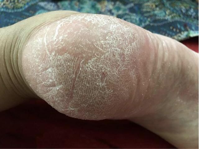 去除脚上老茧老皮的小妙方,脚上老皮老茧去除小妙方