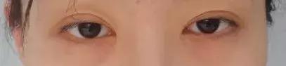 30岁眼部细纹泪沟眼睛显老怎么办,看着像眼袋其实是泪沟