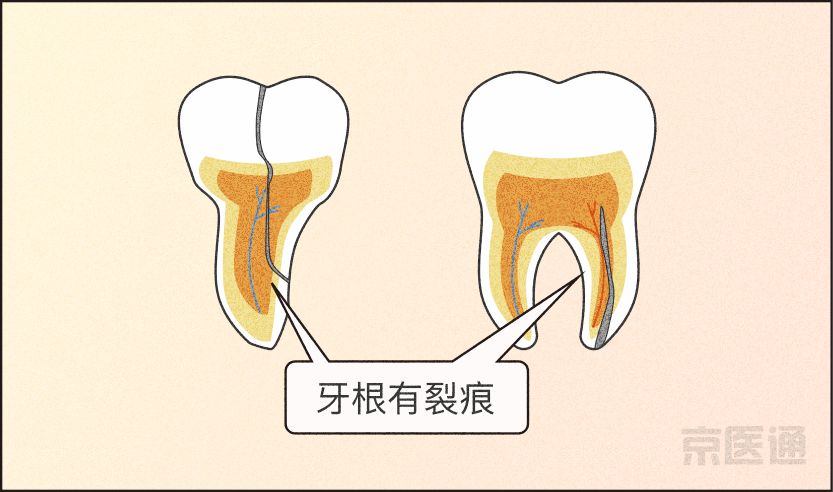 磨牙不好是真的吗,磨牙的危害与关注事项