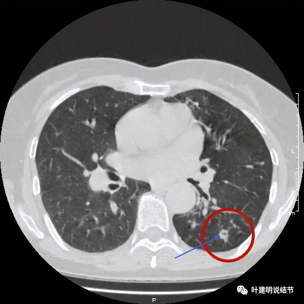 这样的实性结节伴小空洞会是肺癌吗？