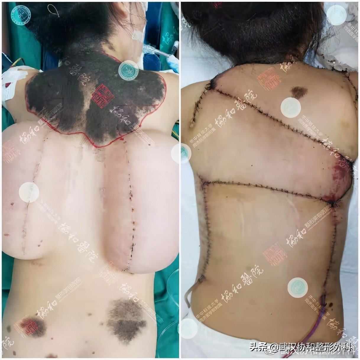 长了很多黑痣是什么原因,不规则的黑痣一定会癌变么