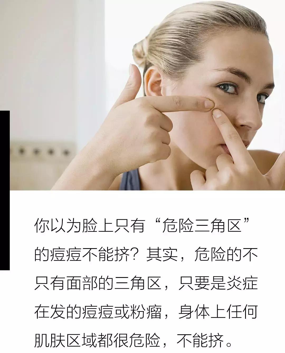 女子挤痘痘颅内感染住进icu,女子挤痘痘引发感染被送急诊