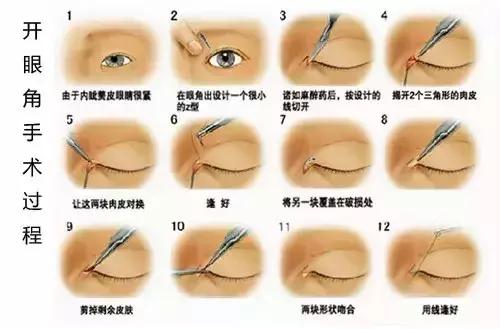 开眼角后吃啥有助于恢复,眼综合全切开眼角恢复过程