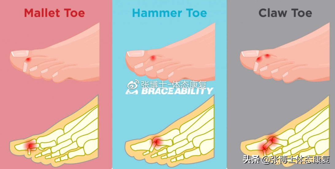 体态矫正之小腿外翻,体态矫正足底