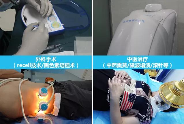 308光疗治疗白癜风副作用,308白癜风光疗后掉皮正常吗