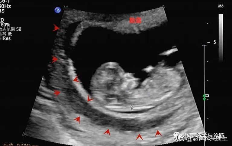 绒毛膜下血肿的超声鉴别诊断,绒毛膜下血肿的症状