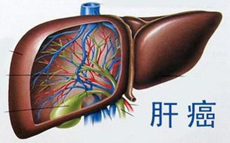 肝癌晚期转移会人财两空吗,肝胆医生在线解答