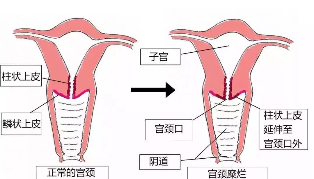 辟谣：这种病距离宫颈癌只有一步之遥？信这个你就被坑了