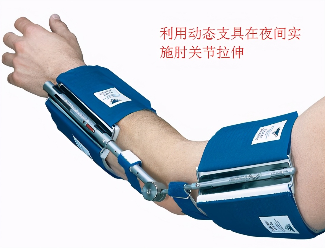 肘关节打石膏10天僵硬,肘关节僵硬最佳恢复时间