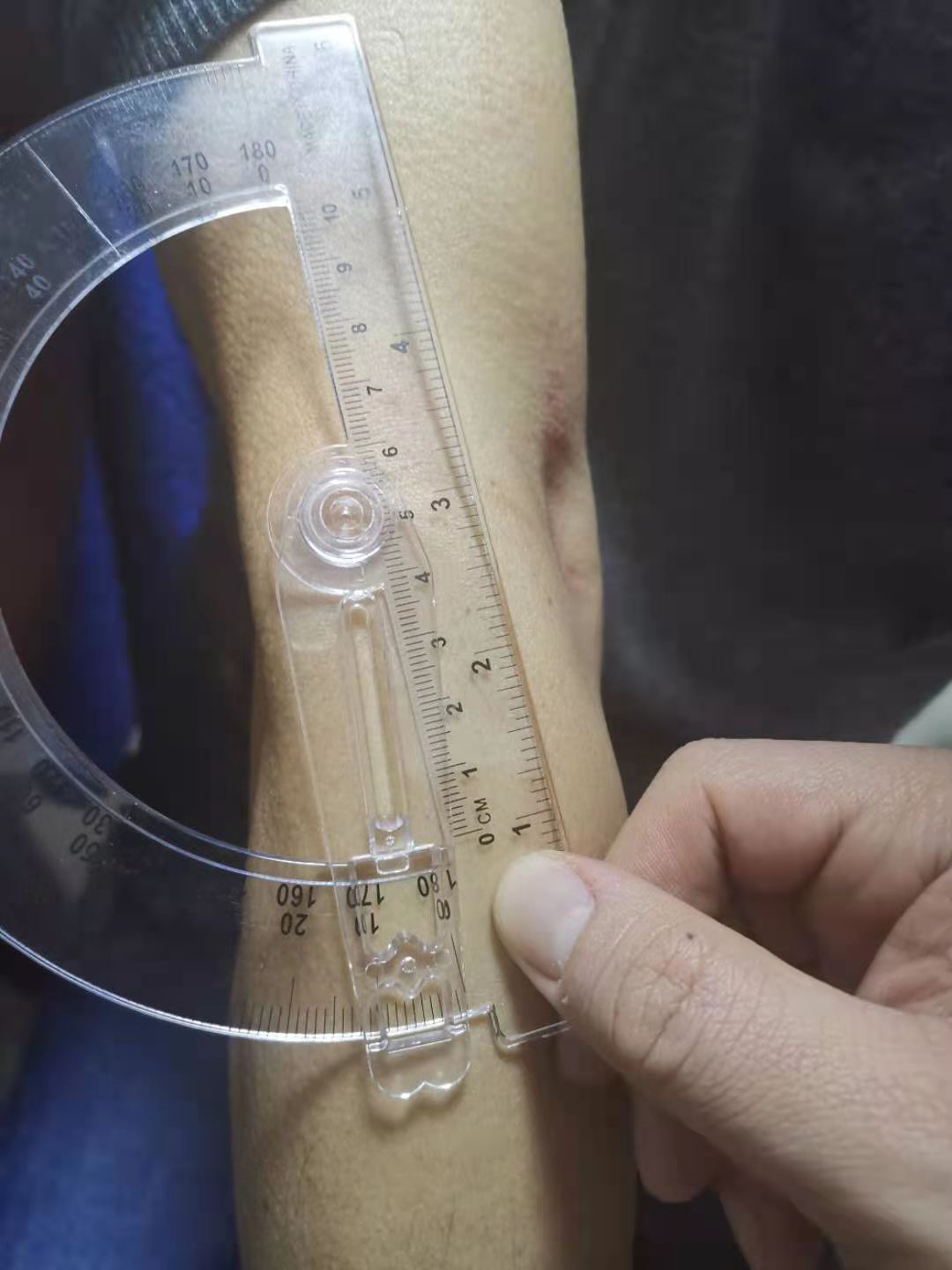肘关节伸不直推拿正骨手法,李德明柔性正骨肘关节