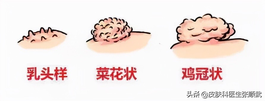 尖锐性湿疣长得像痘痘吗,尖锐性湿疣长得和痘痘一样大
